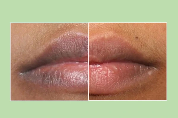 A image portraying normal and dark lips