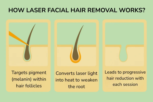 An image showing how does the facial laser hair removal works