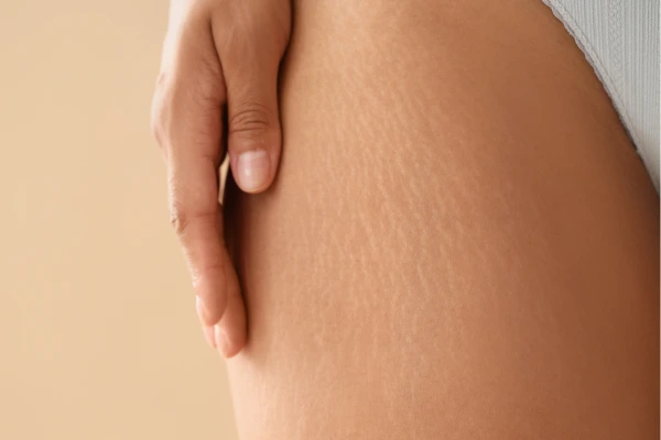 A young women with stretch marks on thighs, buttocks