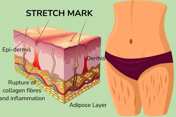 A scientific image that explains how the stretch marks forms