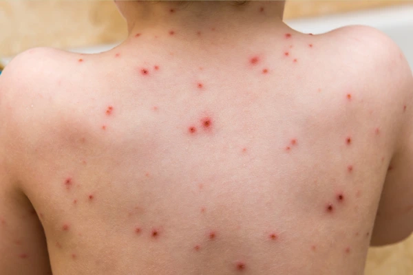 A boy with chickenpox mark on body