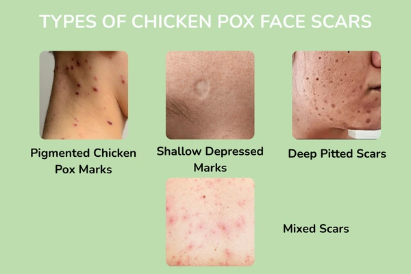Types of chicken pox face scars