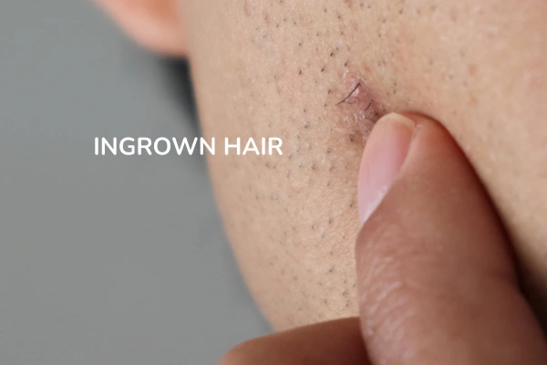 A women with ingrown hair