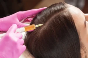 A women taking PRP hair treatment