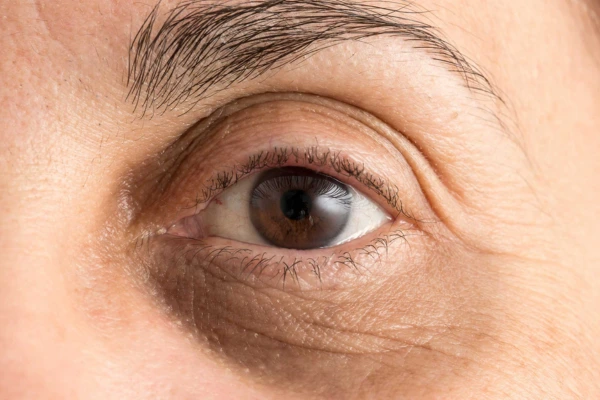 A women with dark circles under eyes