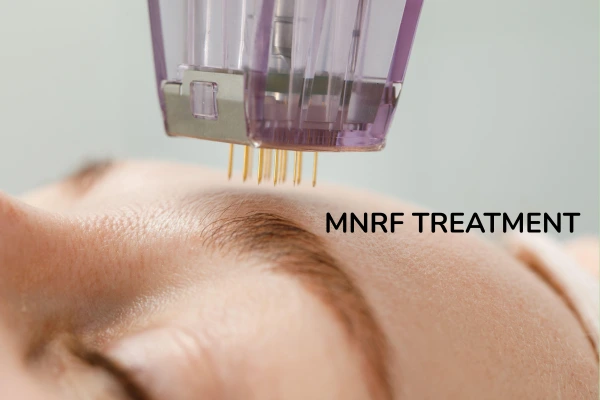 A women taking MNRF treatment