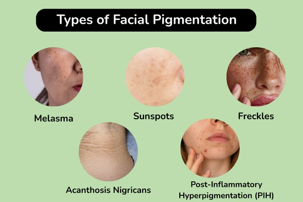 Types of facial pigmentation