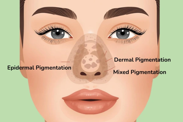 Types of pigmentation on nose