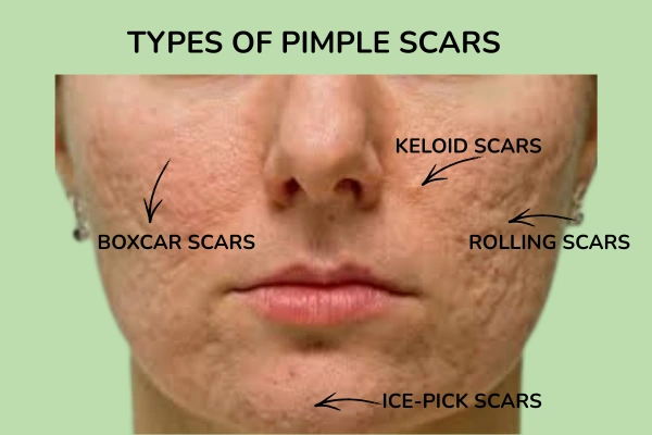 types of pimple scars