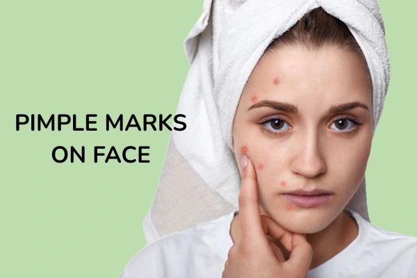 A women pointing her pimple marks on face