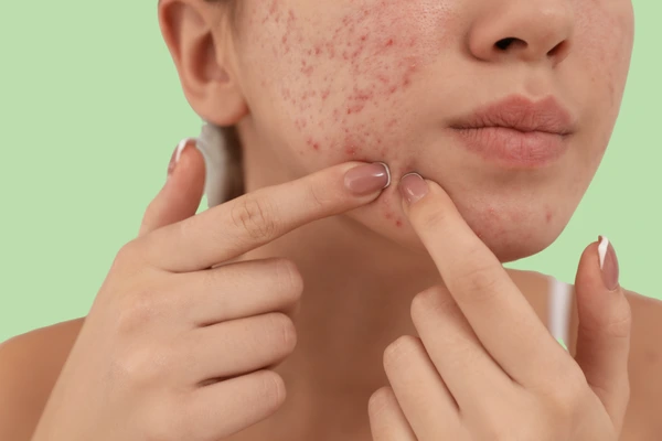 a women pointing her pimple scars or marks on face