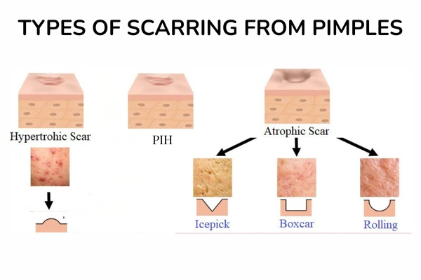 A image with types of pimple scars on face