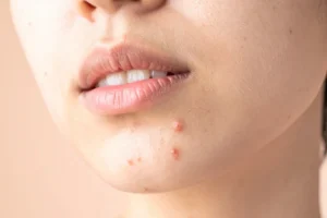 A middle aged women with pimples on chin