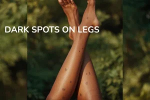 a WOMEN WITH DARK SPOTS ON LEGS