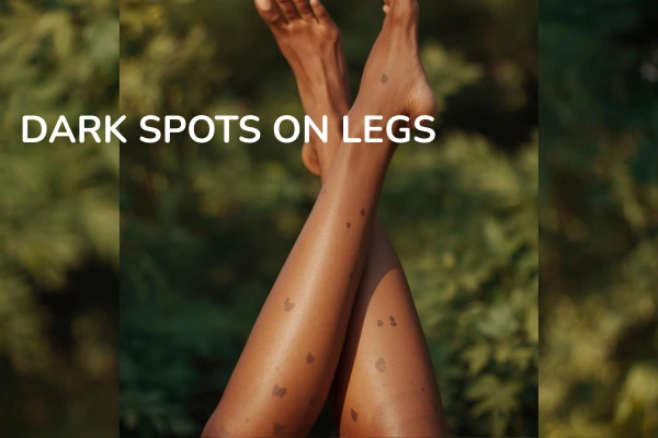 a WOMEN WITH DARK SPOTS ON LEGS