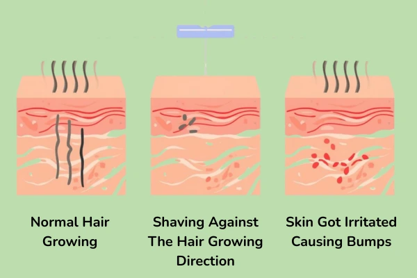 The image that explains how the bumps form after shaving
