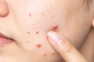 A women with nodular acne