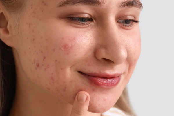 A women with pimple spots on face