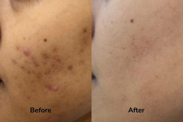 Before and after results of pimple spots on face