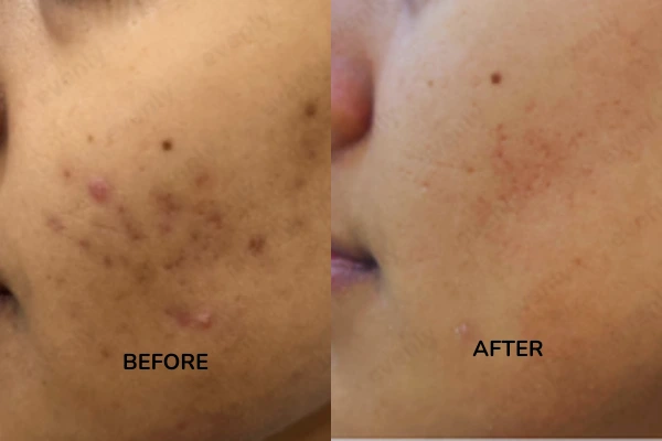 Before and after results of acne scars treatment