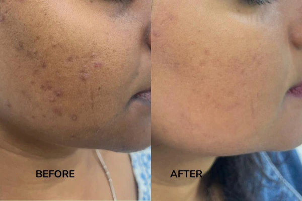 Before and After images of hollywood facial treatment