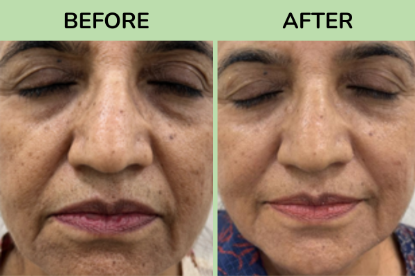 Before and after images of jawline contouring treatment