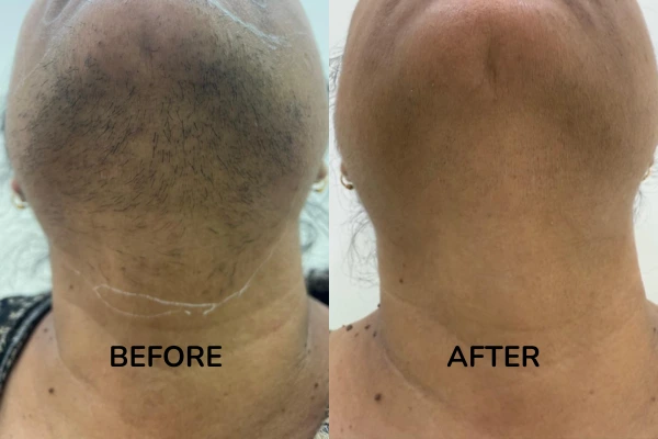 Before and after results for the facial hair removal