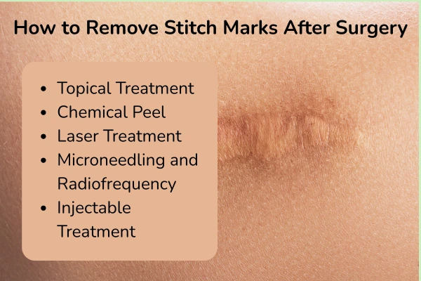 How to remove stitch marks after surgery