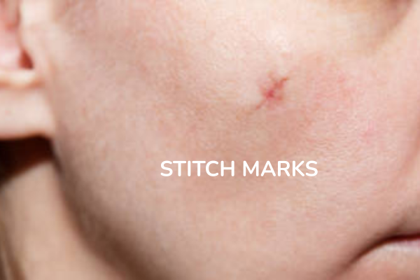 A women with stitch marks