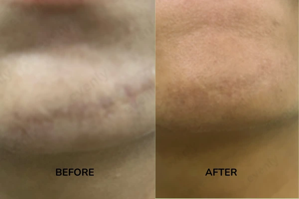 Before and after image of stitch marks on face