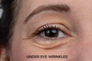 A women with wrinkles under eyes