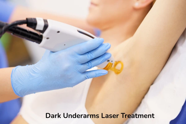 Underarms laser treatment