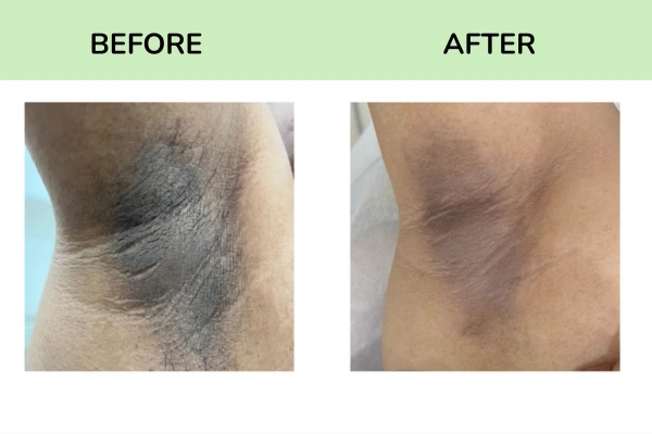 Before and after images of under armpit treatment