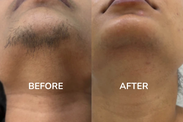 Before and After images of facial hair laser removal treatment