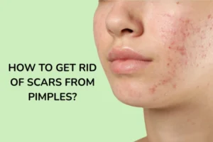 How to Get Rid of Scars From Acne