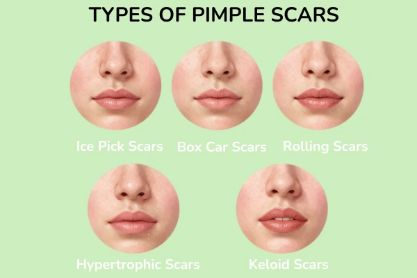 Types of pimple scars