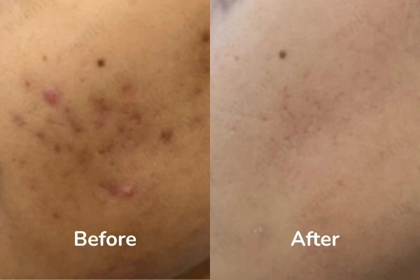 Pimple marks treatment before and after results