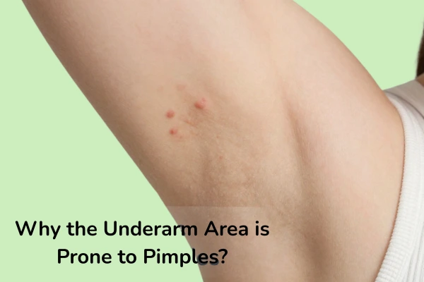 Why underarm area is prone to pimples