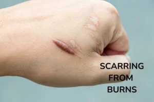 A young man with scarring from burn