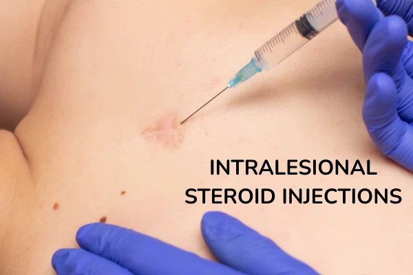 a women taking intralesional steroid injections