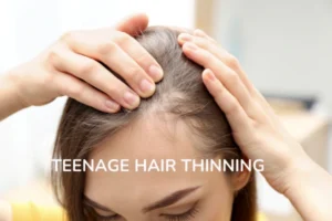 A teenager with hair thinning or hair loss problem
