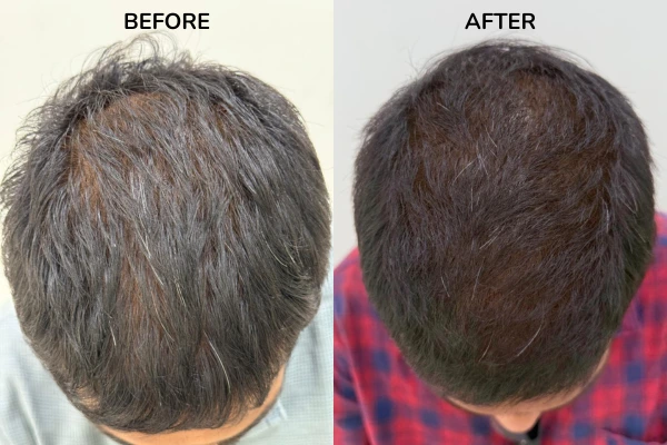 before and after results of teenage hair loss treatment