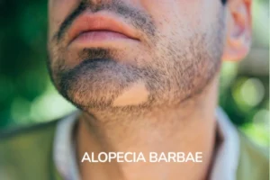 A young men with Alopecia barbae