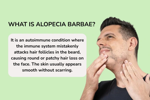 Alopecia barbae