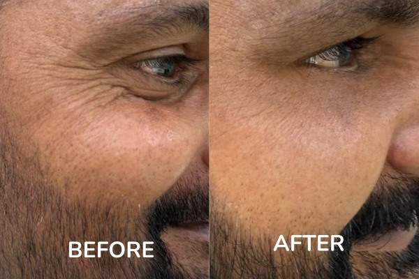 Before and after images of evenly's under eye wrinkles treatment