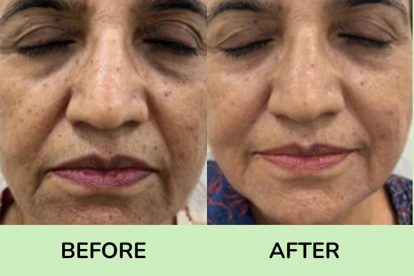 Before and after images of skin tightening treatment