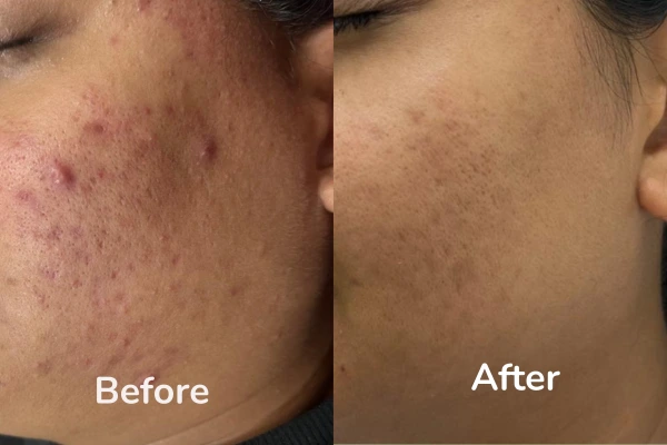 Before and after images of pimples scar treatment