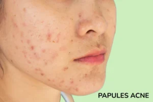A women with papules pimples