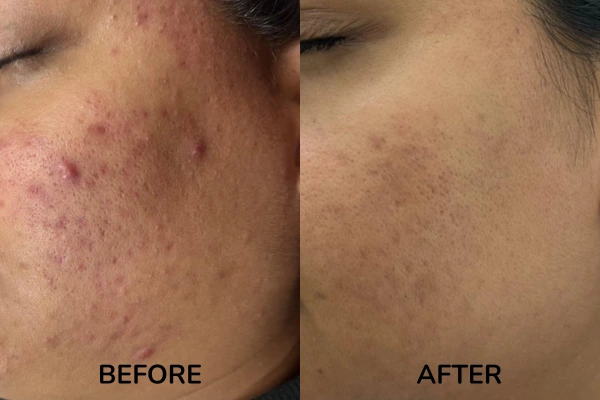 Before and after images of papaules acne treatment