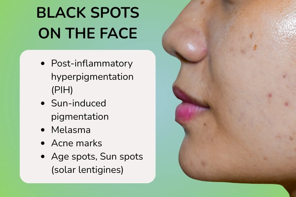 Types of black spots on face